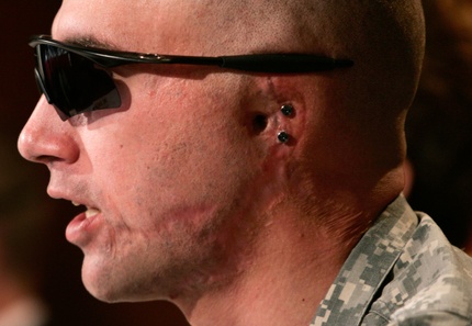 Woundedalexwonggetty