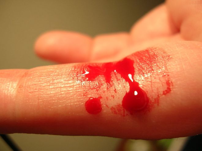 Bleeding_finger