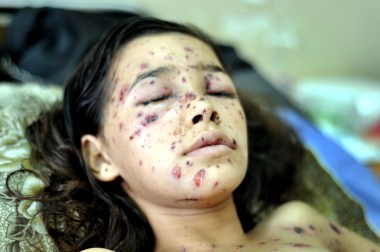 Palestinian Dina in difficulty opening her eyes