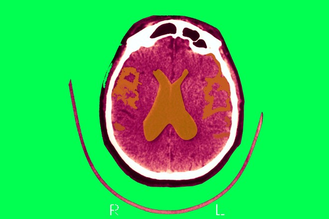 Alzheimer'S Disease, Scan